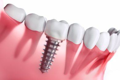 Implantes Dentários